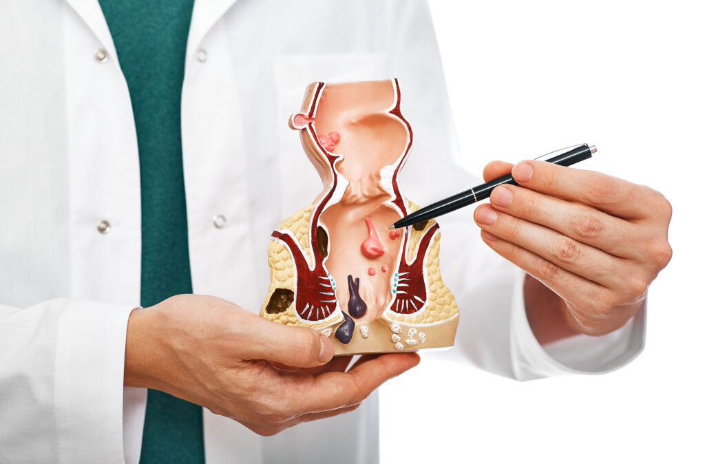 Proctologist pointing pen rectum pathologies on an anatomical model